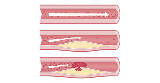 動脈硬化過程 動脈硬化過程